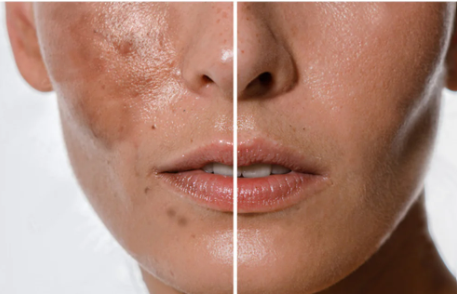 Hyperpigmentation & Dark Spots